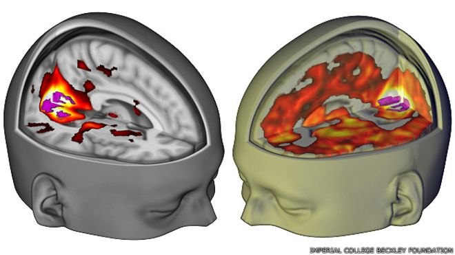 Así se ve el cerebro bajo los efectos del LSD